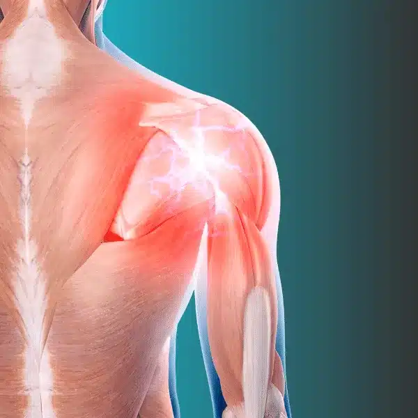 Pompano Beach Chiropractic Clinic therapist treating frozen shoulder patient